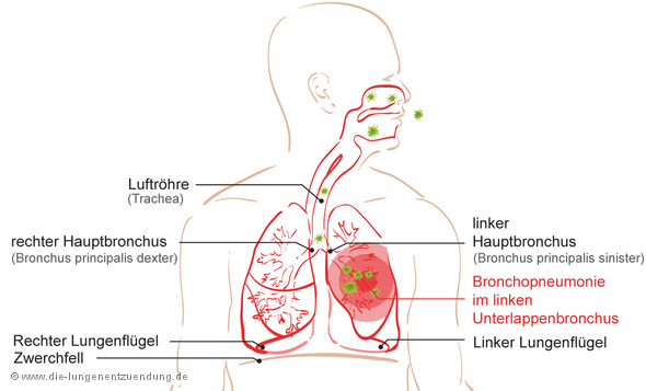 Darstellung einer Bronchopneumonie