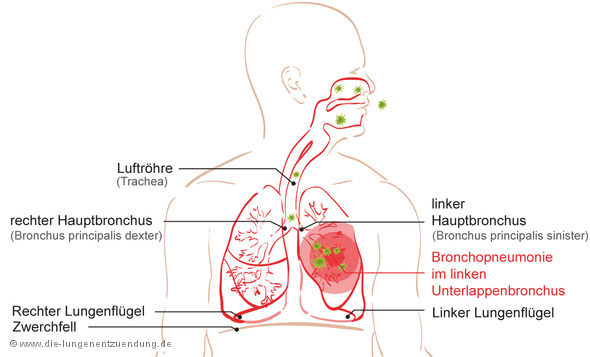 Bronchopneumonie