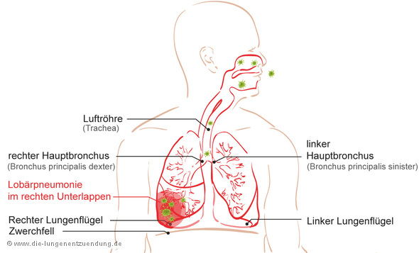 Darstellung einer Lobärpneumonie