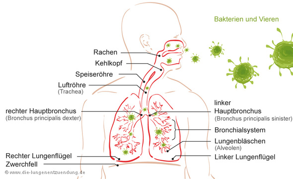 Pneumonie durch Infektion